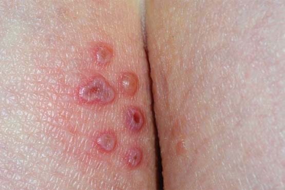 Herpes bilder genital ▷ Herpes